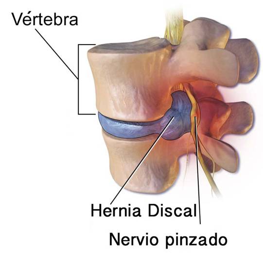 Hernia de disc lombară | Move&Flex