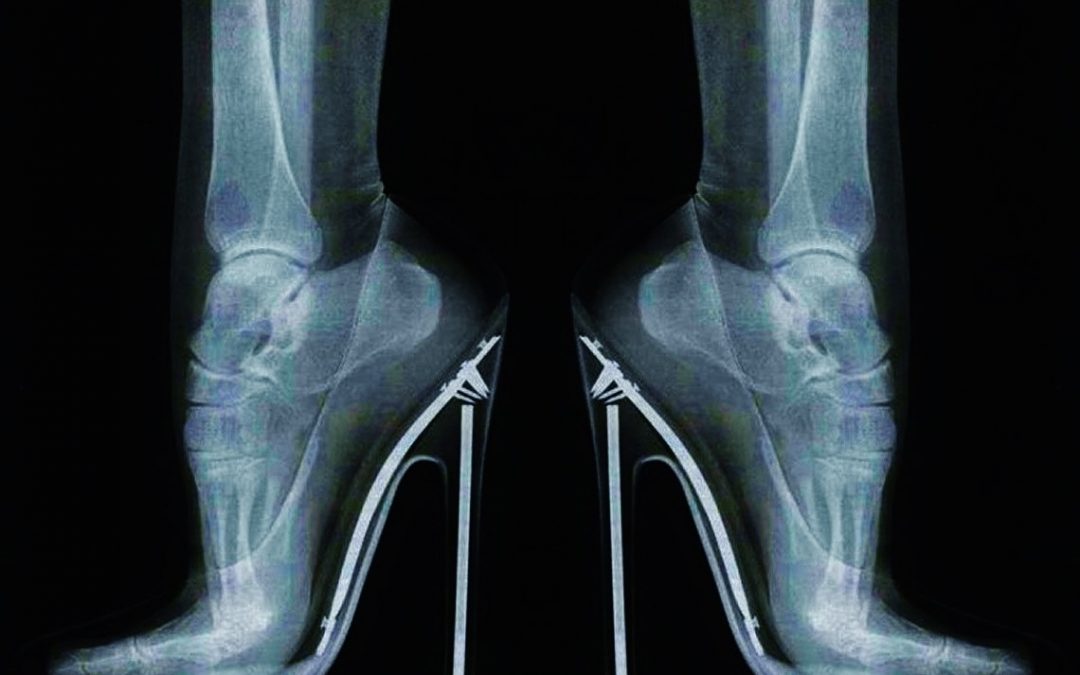 Los tacones generan más que dolor de pies