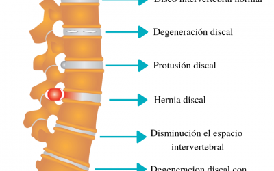 Hernia discal lumbar y tratamiento quiropráctico
