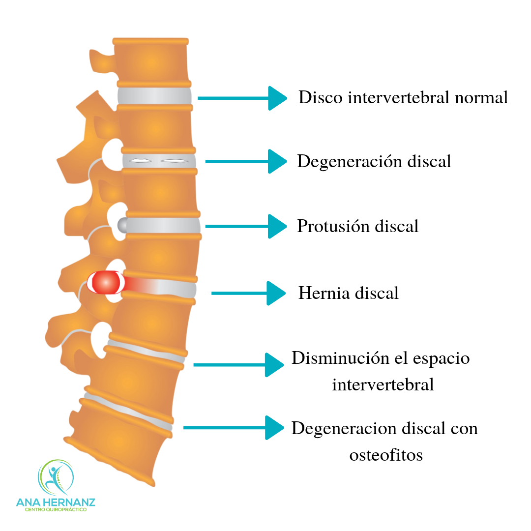 Marinero Estrella Aburrir Hernia discal lumbar y tratamiento quiropráctico - Ana Quiropractica | Tu  quiropractico en Majadahonda